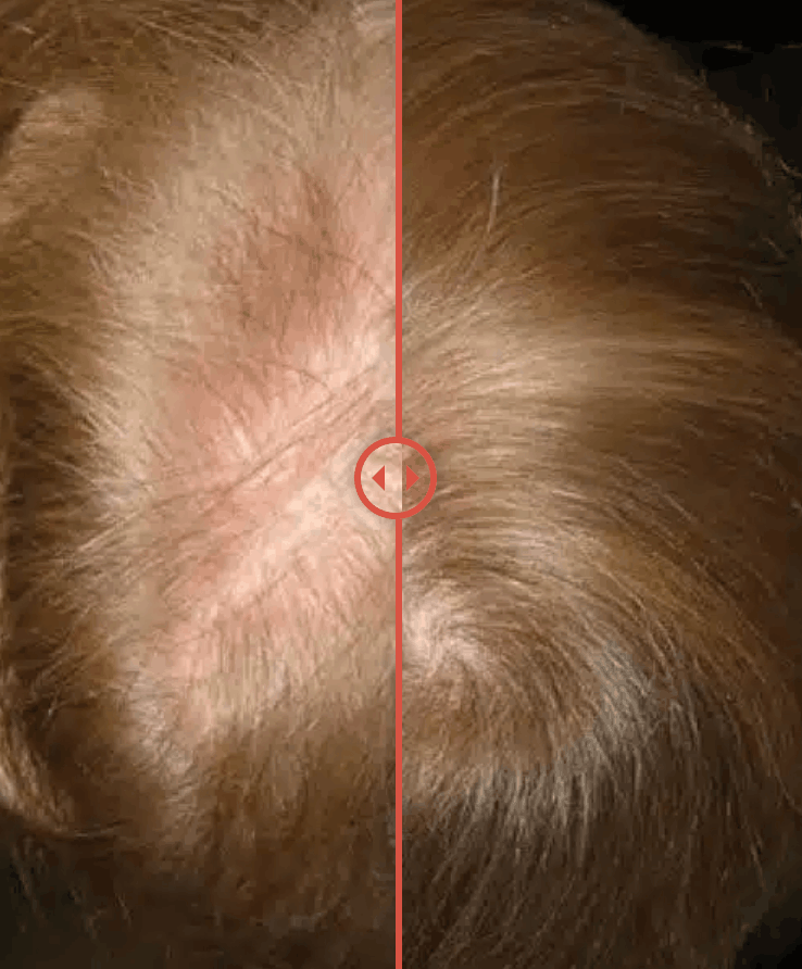 Increases Scalp Microcirculation image