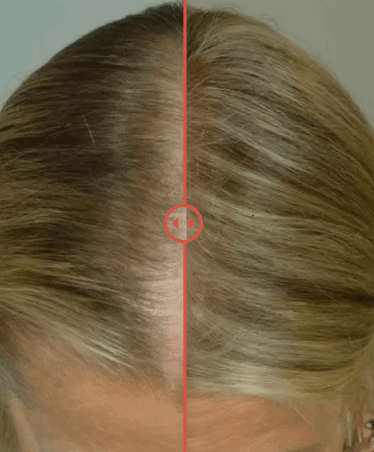 Blocks DHT directly at the Scalp image